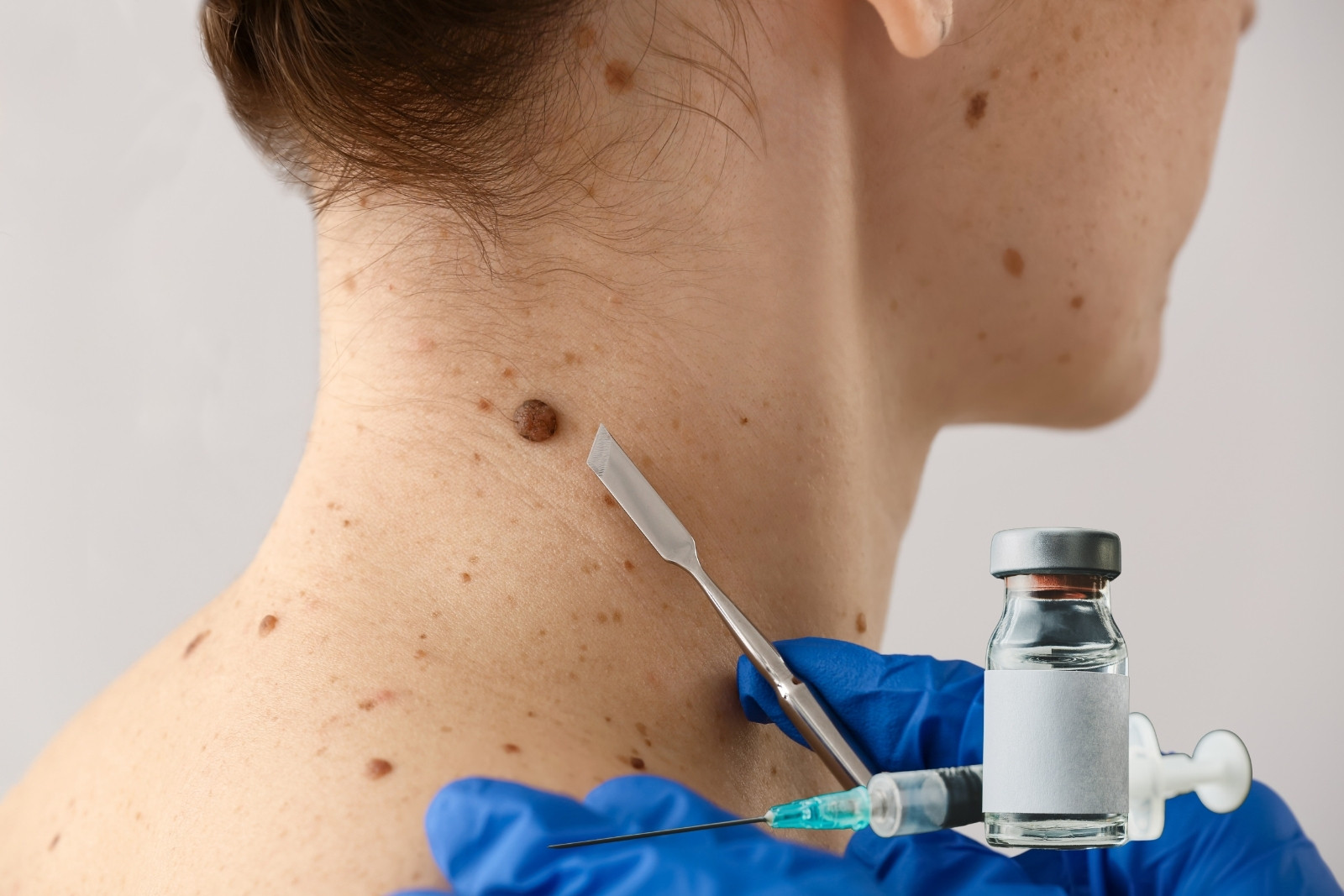 Cilt kanserinde mRNA aşısı mucizesi, tekrarlama ve yayılma riskini azaltıyor
