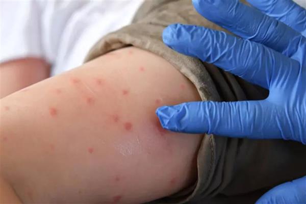 Çin'den bir virüs alarmı daha: Bir kişide Chikungunya çıktı, 8 bin kişi riskli ilan edildi
