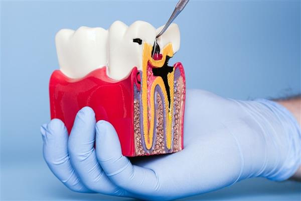 Çürükler ve diş eti hastalıkları felç riskini iki katına çıkarabilir