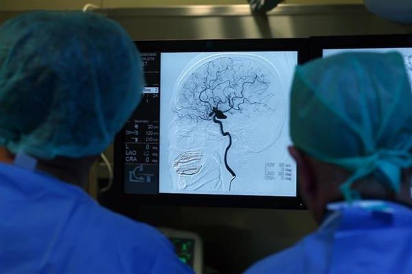 Türk Beyin Damar Hastalıkları Derneği: Türkiye'de her yıl yaklaşık 100 bin kişi inme geçiriyor