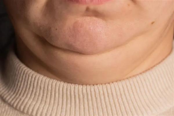 Uzmanlara göre boyun kalınlığı, obezite ve kalp hastalıklarının erken uyarı sinyali olabilir