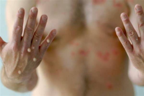 Mpox virüsünde yeni varyantın görülmesi sonrası uzmanlar aşı hatırlatması yaptı