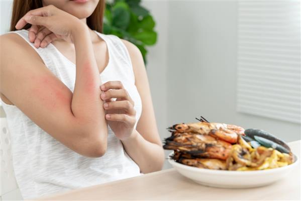 Her 20 çocuktan birinde 6 yaşına kadar gıda alerjisi görülebilir